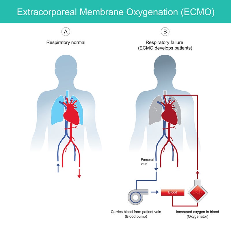 ECMO Illustratoin