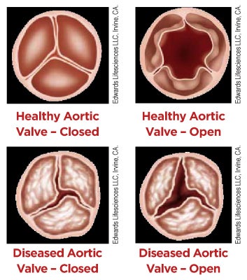 Healthy and Diseased Heart Valves